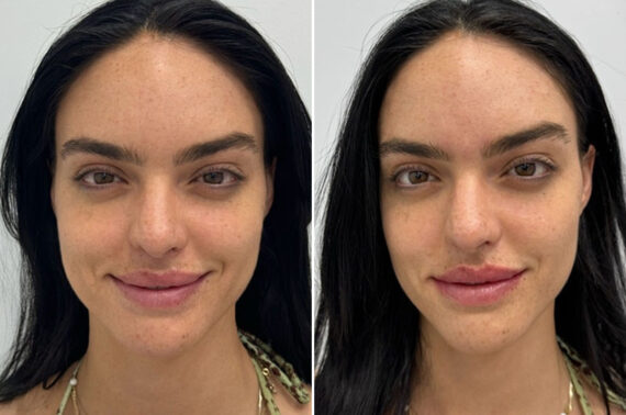 Lip Fillers Before and After Photos in Miami Beach, FL, Patient 2976