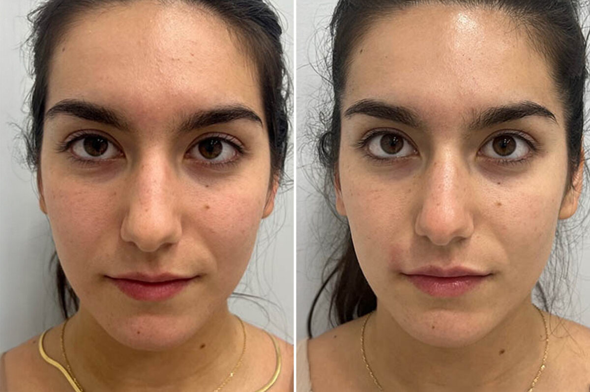 Lip Fillers Before and After Photos in Miami Beach, FL, Patient 2983