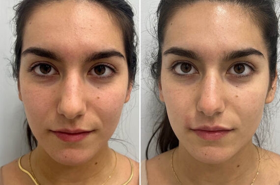 Lip Fillers Before and After Photos in Miami Beach, FL, Patient 2983