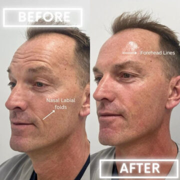 Botox Before and After Photos in Miami Beach, FL, Patient 1847