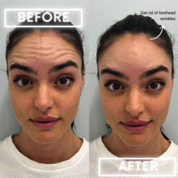 Botox Before and After Photos in Miami Beach, FL, Patient 1849