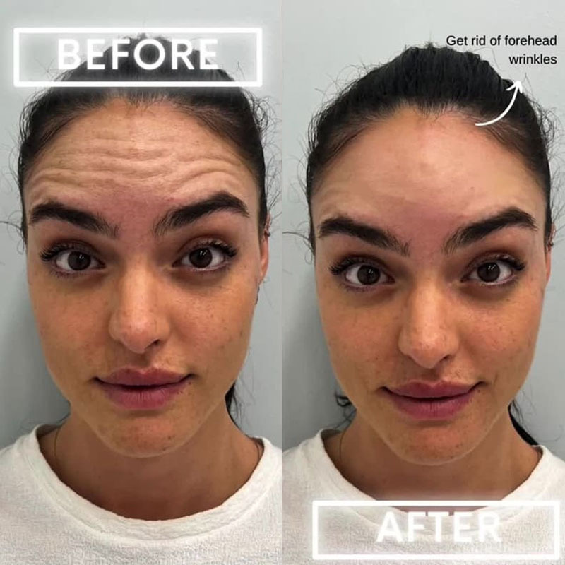 Patient Botox Before After 2
