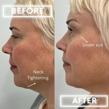 Botox Before and After Photos in Miami Beach, FL, Patient 1851