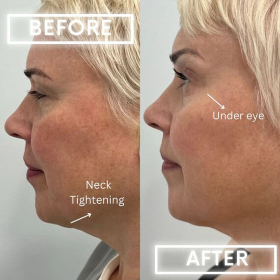 Botox Before and After Photos in Miami Beach, FL, Patient 1851