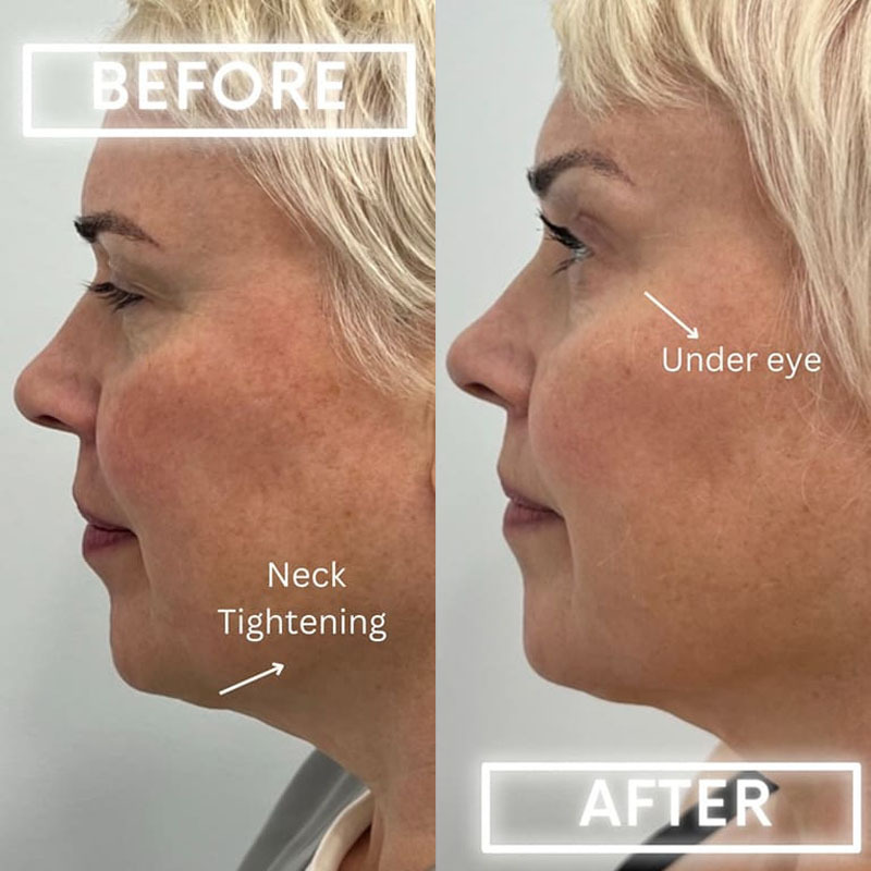 Patient Botox Before After 3