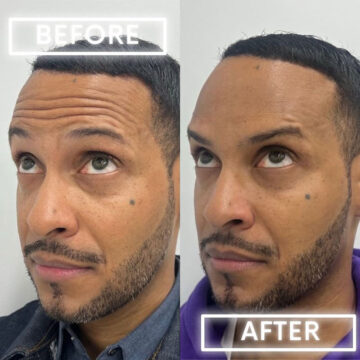 Botox Before and After Photos in Miami Beach, FL, Patient 1839