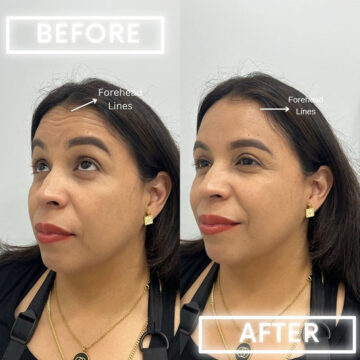 Botox Before and After Photos in Miami Beach, FL, Patient 1857