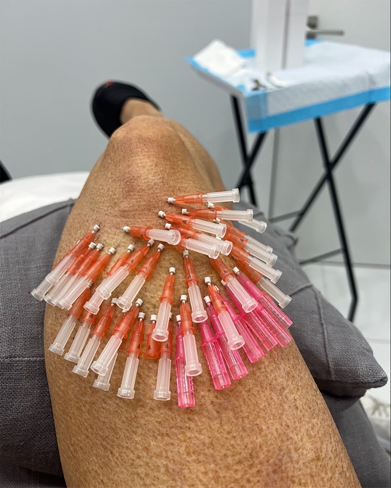 Close-up of PDO threads inserted around the knee for non-surgical lifting and collagen stimulation treatment.