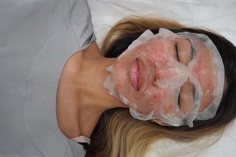 Woman with redness and mask post-PRP facial treatment to boost collagen and improve skin texture naturally