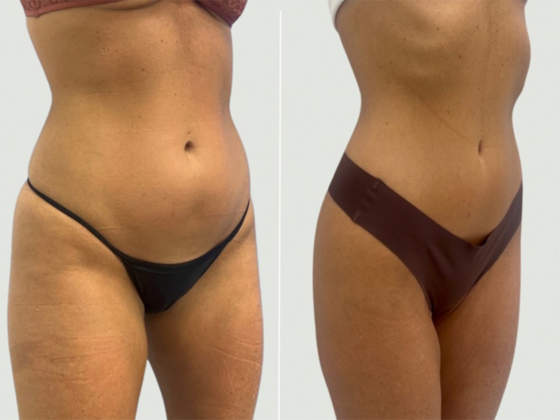 Side-by-side before and after images showing a woman's toned waist after Semaglutide weight loss treatment.