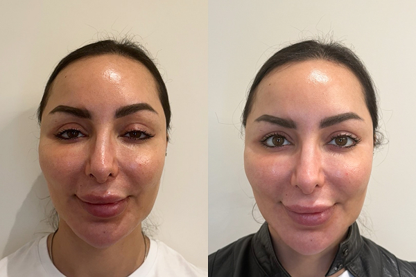 Before and After