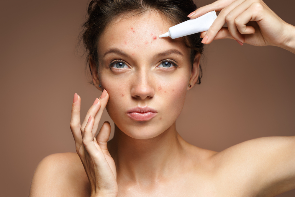 Woman applying acne treatment to forehead, representing BODYWELLE’s targeted care for various acne types including cystic and hormonal.