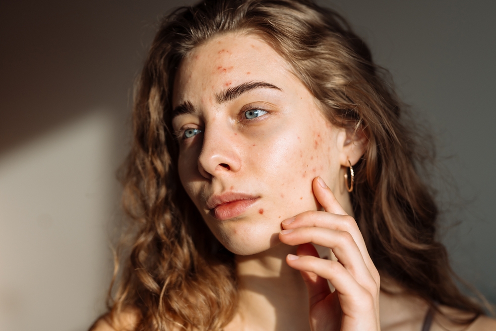 Woman with acne-prone skin considering medical-grade skincare, highlighting BODYWELLE's expert-recommended at-home acne treatments.