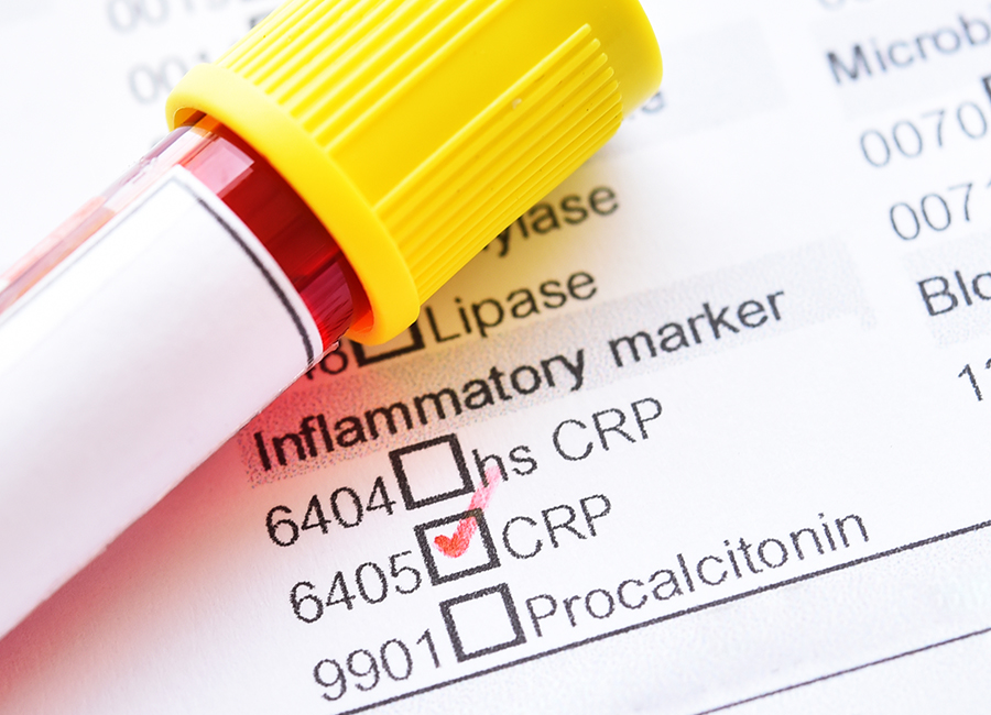 Close-up of CRP blood test tube and lab form highlighting inflammation panel used to detect chronic inflamm-aging markers