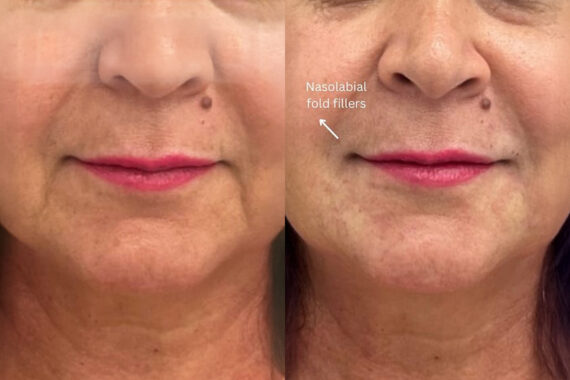 Fillers Before and After Photos in Miami Beach, FL, Patient 2720