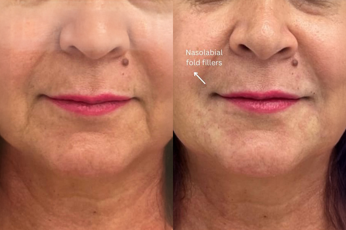 Fillers Before and After Photos in Miami Beach, FL, Patient 2720