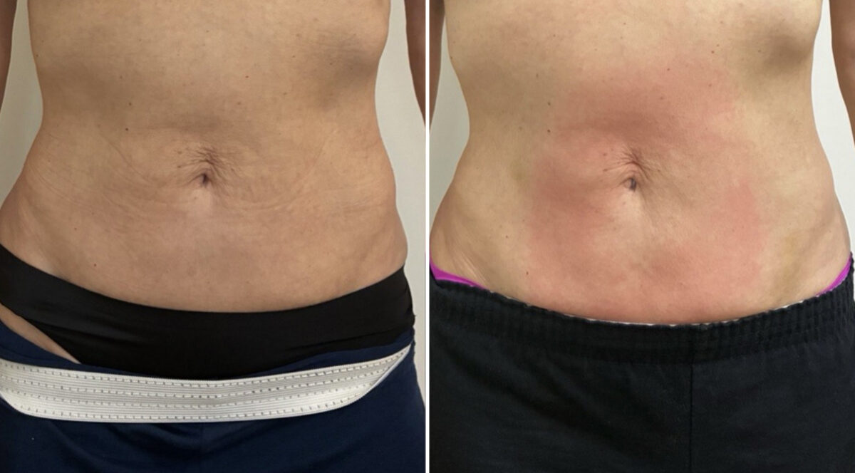 EMSculpt NEO Before and After Photos in Miami Beach, FL, Patient 5740