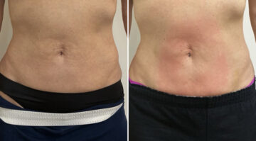 EMSculpt NEO Before and After Photos in Miami Beach, FL, Patient 5740