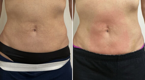 EMSculpt NEO Before and After Photos in Miami Beach, FL, Patient 5740