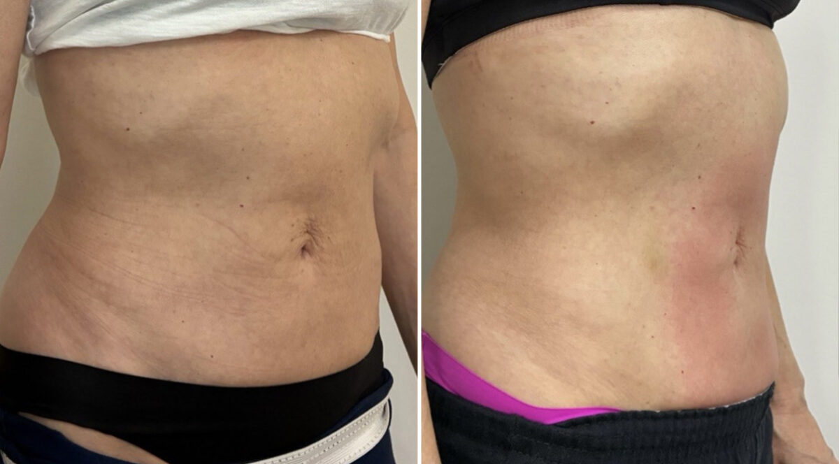 EMSculpt NEO Before and After Photos in Miami Beach, FL, Patient 5740
