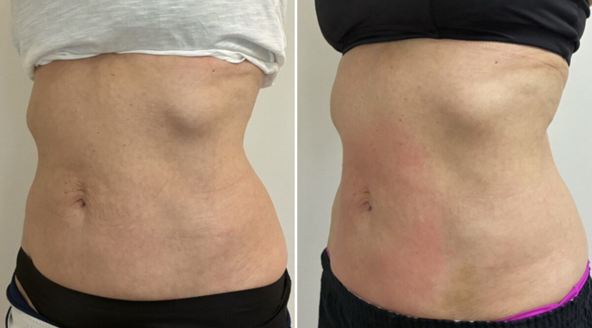 EMSculpt NEO Before and After Photos in Miami Beach, FL, Patient 5740
