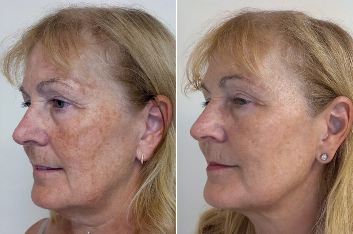 IPL Treatment Before and After Photos in Miami Beach, FL, Patient 6056