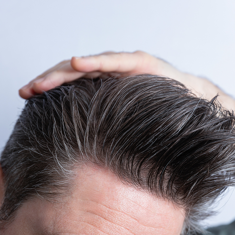 Close-up of man's scalp showing healthy hair growth after PRF hair restoration treatment for follicle stimulation