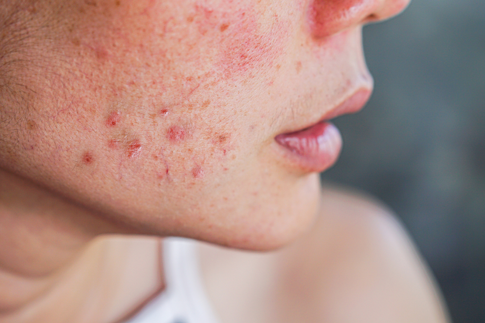Rosacea Acne BODYWELLE Miami Beach