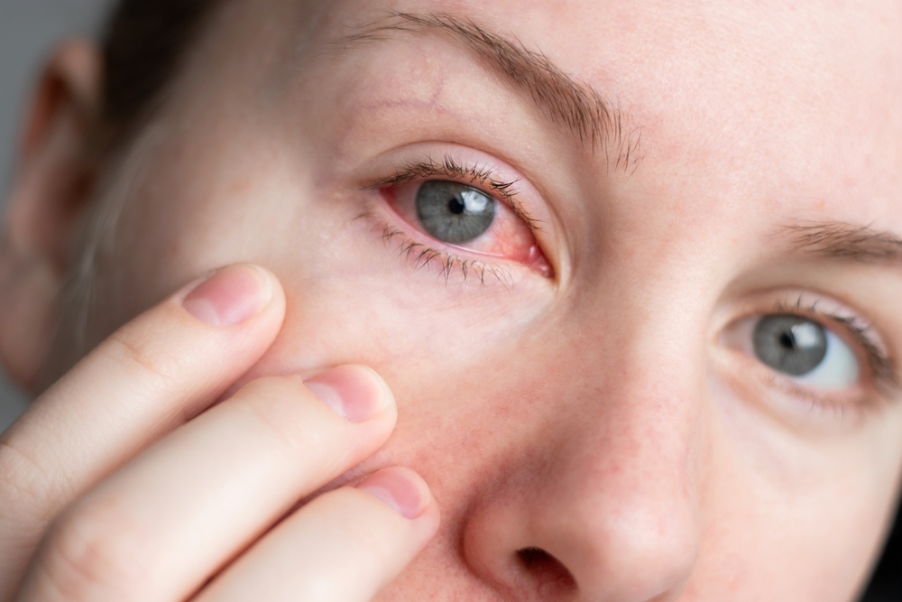Rosacea Eyes BODYWELLE Miami Beach