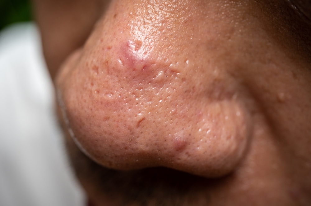 Rosacea Nose BODYWELLE Miami Beach