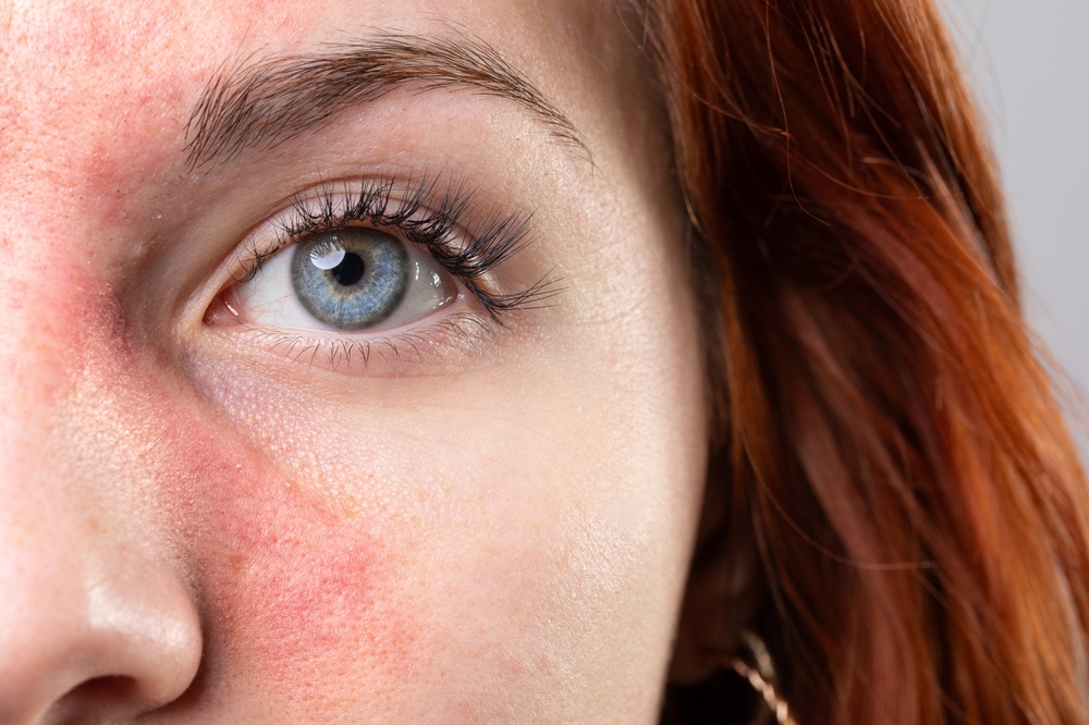 Rosacea Skin BODYWELLE Miami Beach