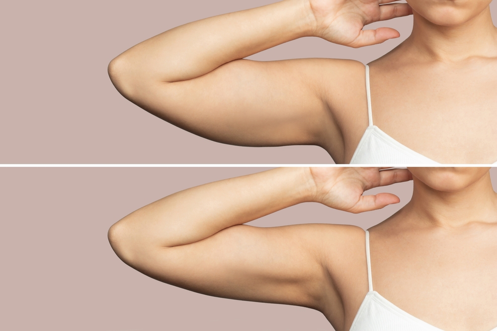 Skin Arms Rejuvenation Dr. Alonso Martin in Miami Beach