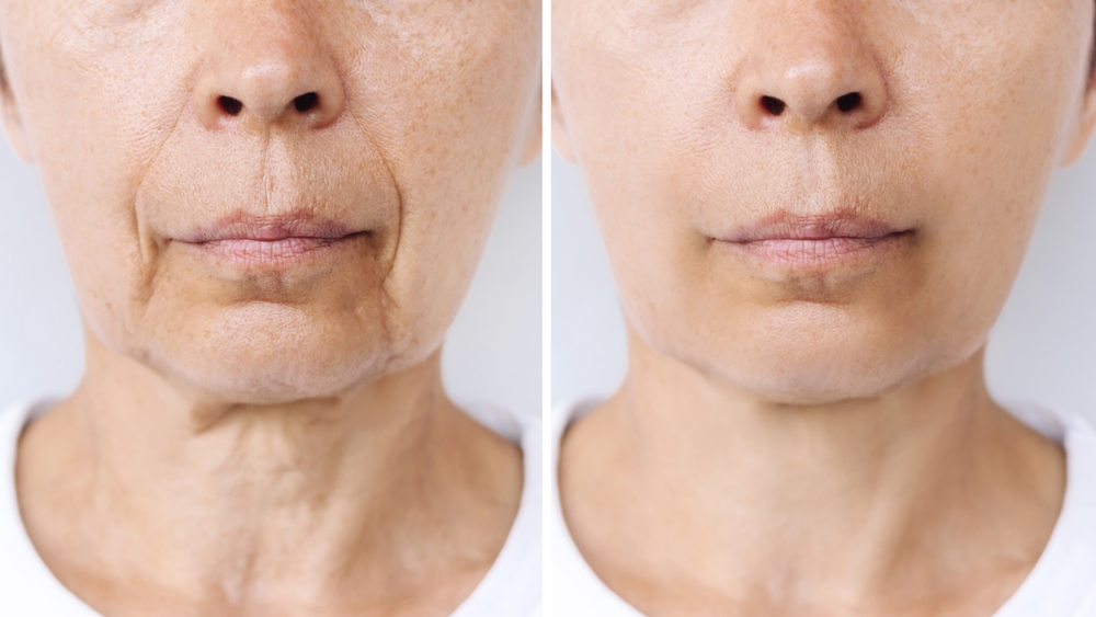 Skin Neck Rejuvenation Dr. Alonso Martin in Miami Beach