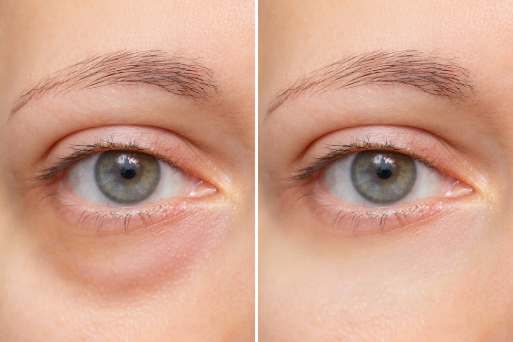 Skin Under Eye Rejuvenation Dr. Alonso Martin in Miami Beach