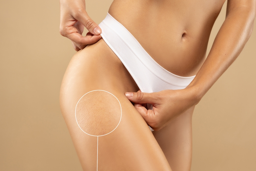 Close-up of woman's thigh with visible stretch marks, highlighting BODYWELLE’s combined treatment approach for skin smoothing and collagen repair.