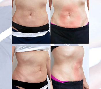 emsculpt at bodywelle