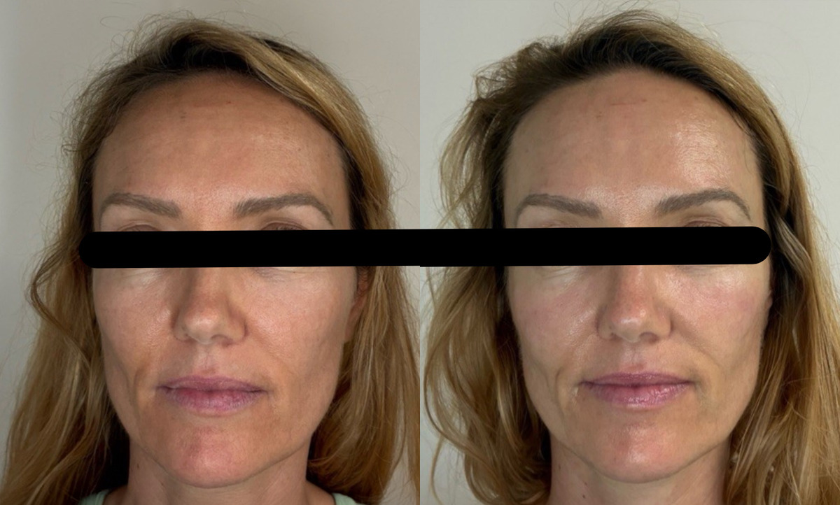 Facial Balancing Before and After Photos in Miami Beach, FL, Patient 10533
