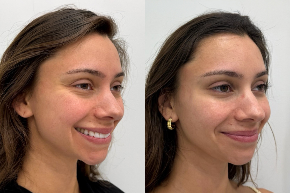 Botox Before and After Photos in Miami Beach, FL, Patient 9365