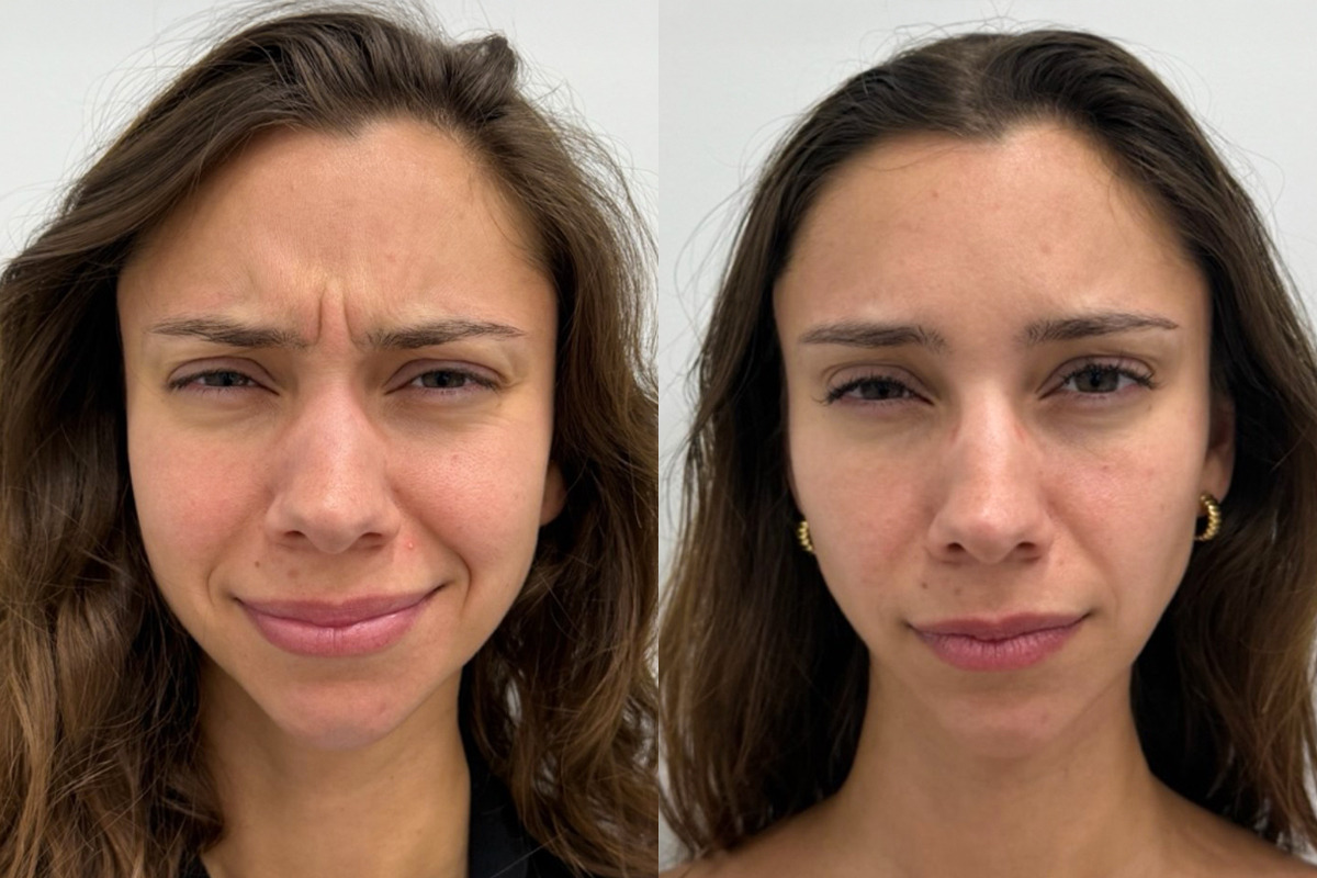 Botox Before and After Photos in Miami Beach, FL, Patient 9365