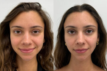 Botox Before and After Photos in Miami Beach, FL, Patient 9365