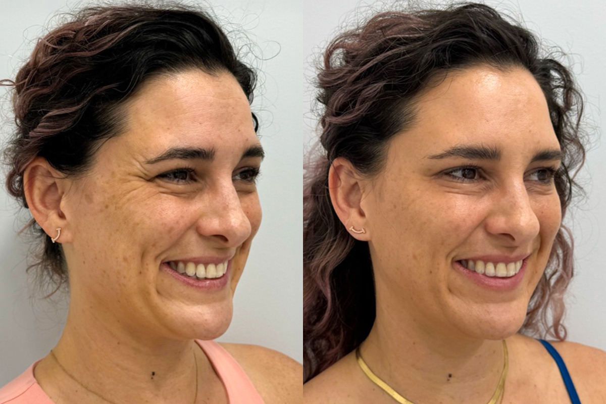 Botox Before and After Photos in Miami Beach, FL, Patient 9375