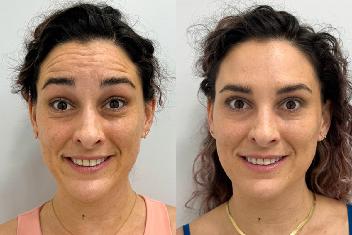 Botox Before and After Photos in Miami Beach, FL, Patient 9375