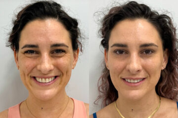 Botox Before and After Photos in Miami Beach, FL, Patient 9375