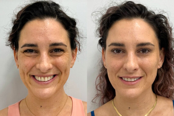 Botox Before and After Photos in Miami Beach, FL, Patient 9375