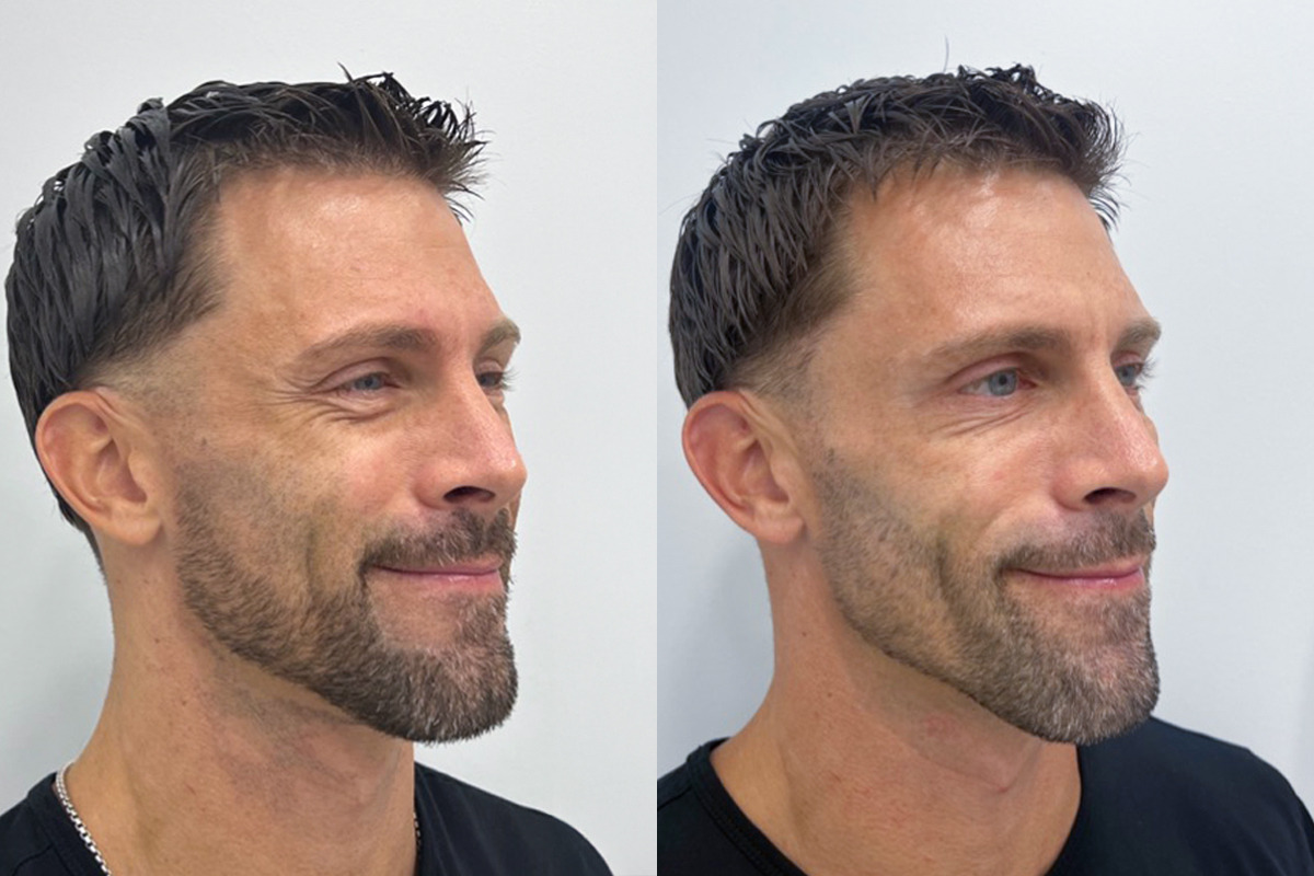Botox Before and After Photos in Miami Beach, FL, Patient 9388