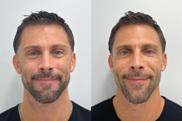 Botox Before and After Photos in Miami Beach, FL, Patient 9388