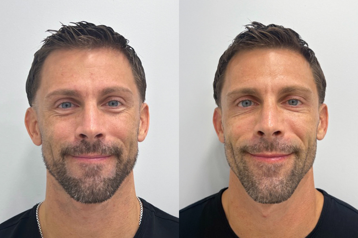 Botox Before and After Photos in Miami Beach, FL, Patient 9388