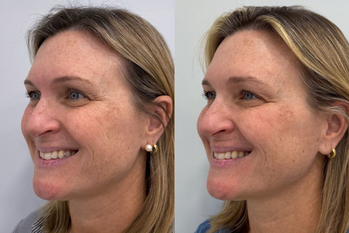 Botox Before and After Photos in Miami Beach, FL, Patient 9395