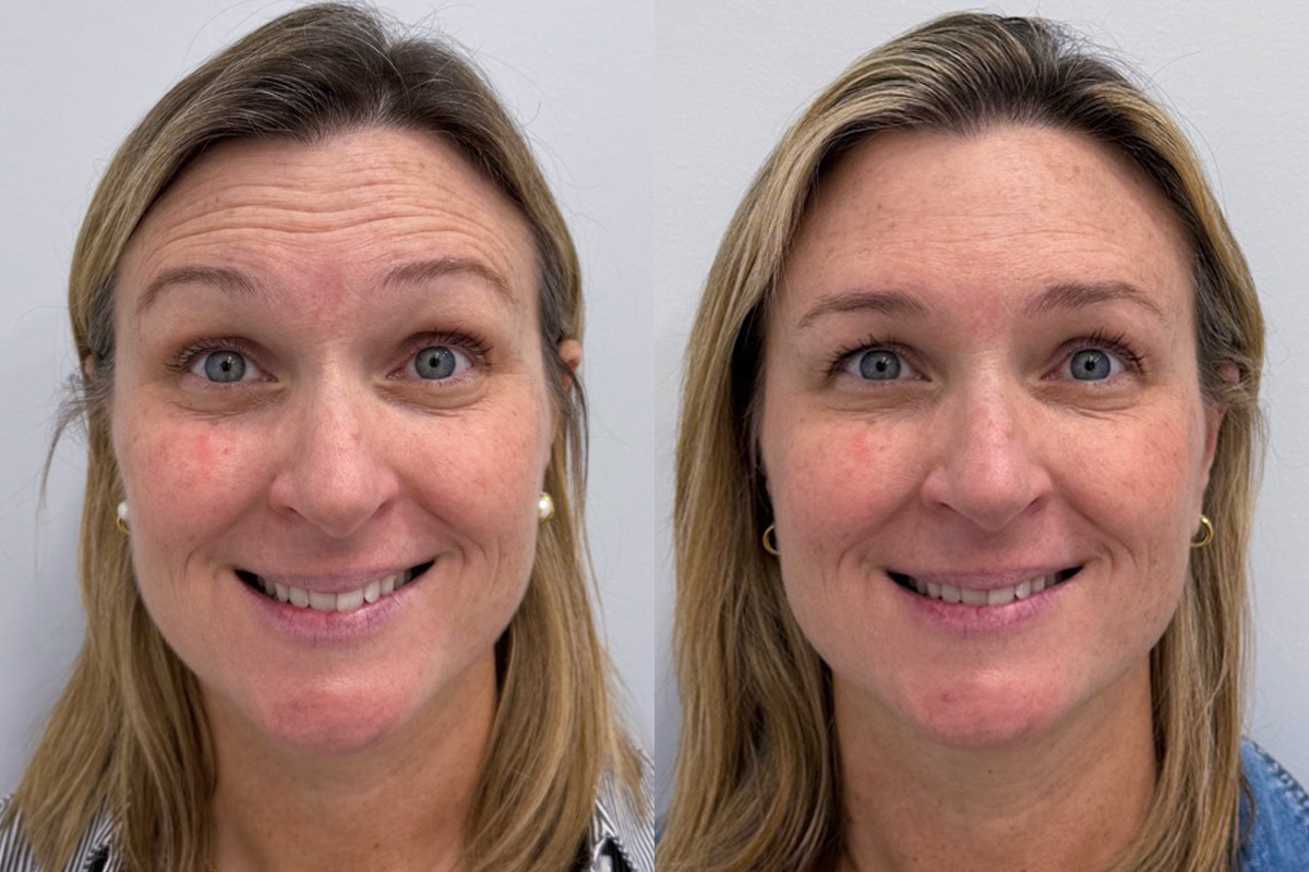 Botox Before and After Photos in Miami Beach, FL, Patient 9395