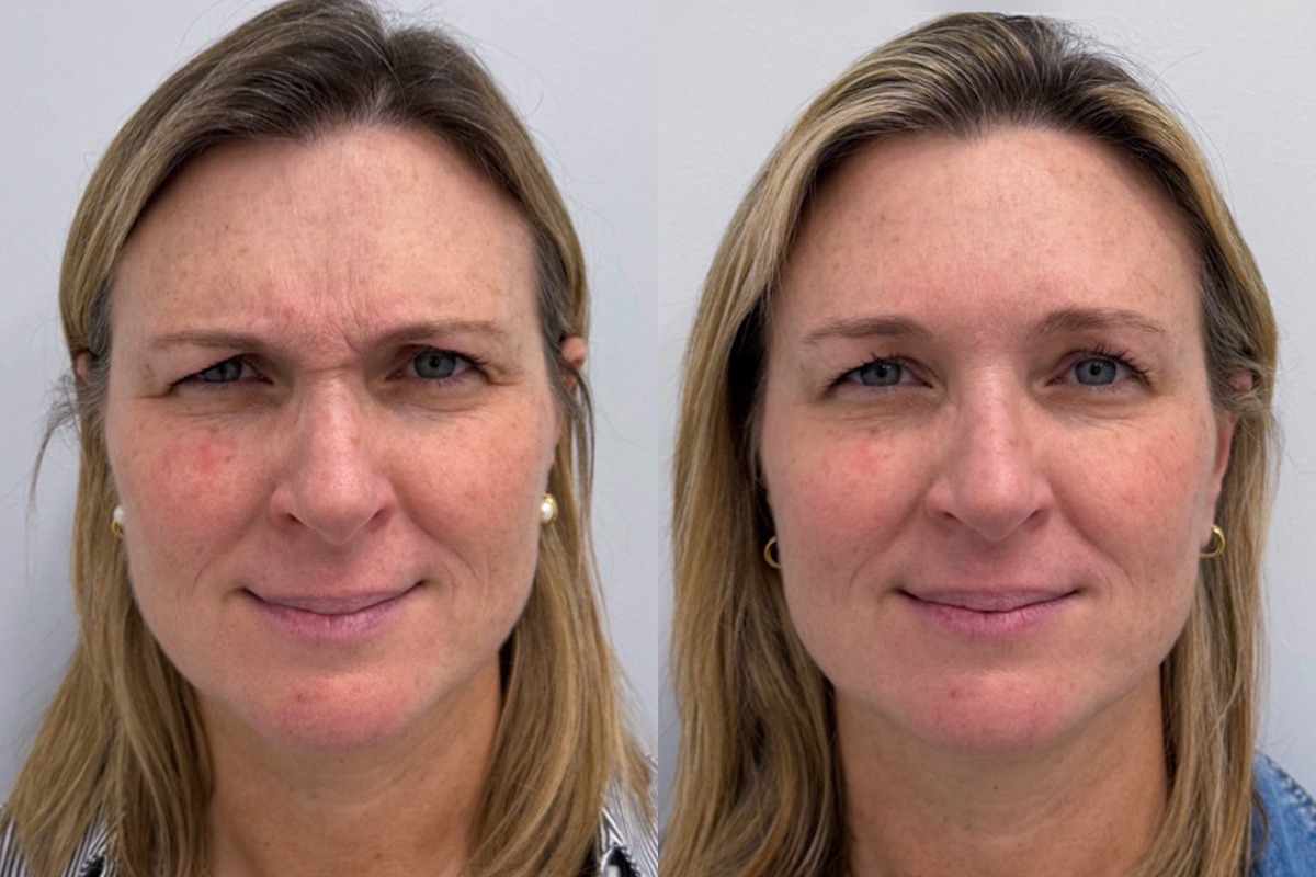 Botox Before and After Photos in Miami Beach, FL, Patient 9395